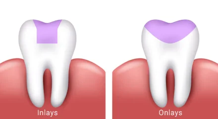 inlay-ve-onley