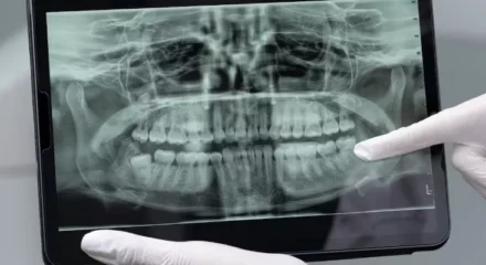 dental-panaromik-x-ray-694a8843e5195