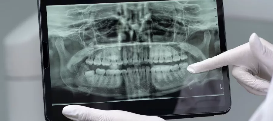 dental-panaromik-x-ray-694a8843e5195