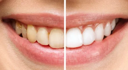 dis-beyazlatma-694a4efe9537b