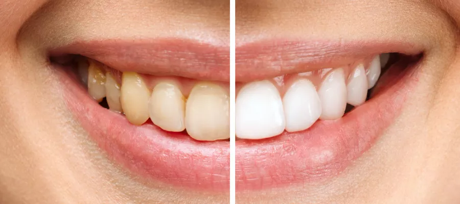 dis-beyazlatma-694a4efe9537b