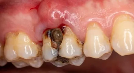 dis-lezyonu-694a7d9d72188