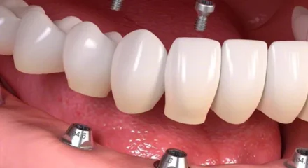 implant-ustu-protez-2