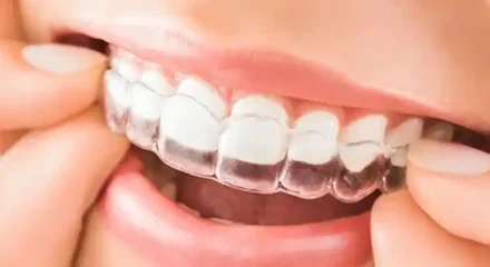 invisalign (Özel)