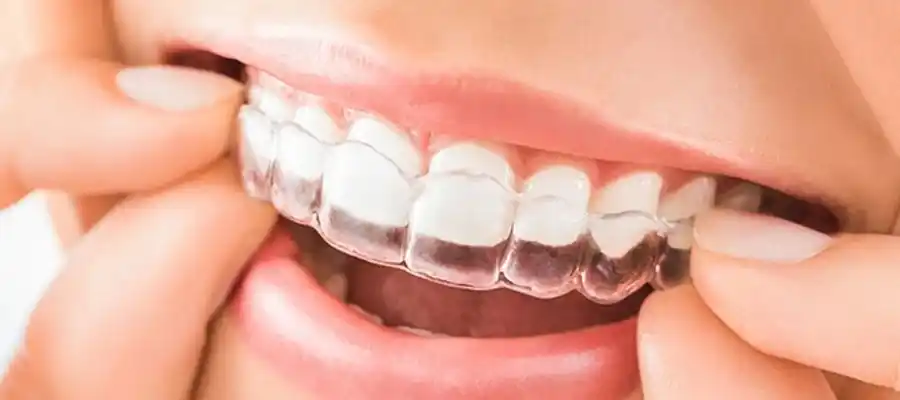 invisalign (Özel)