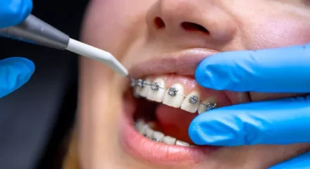 ortodontik-tedavi-694a667c7fe82