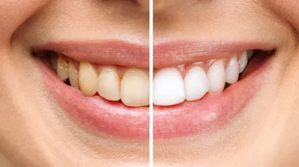 dis-beyazlatma-2-694a4eff122d8